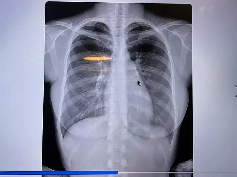 《写真偶像公开胸部X光照片》怀疑丰胸的人可以闭嘴了插图7
