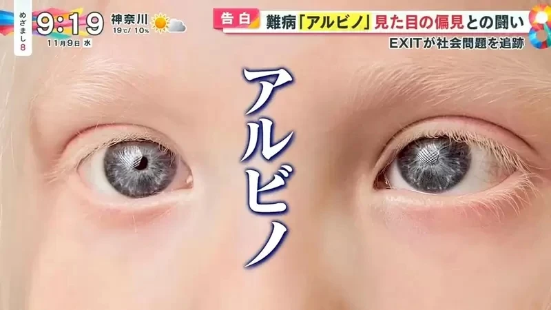 《白化症患者吐槽二次元》动漫里的白化症都是美少年美少女？害她从小总是莫名被嫌丑