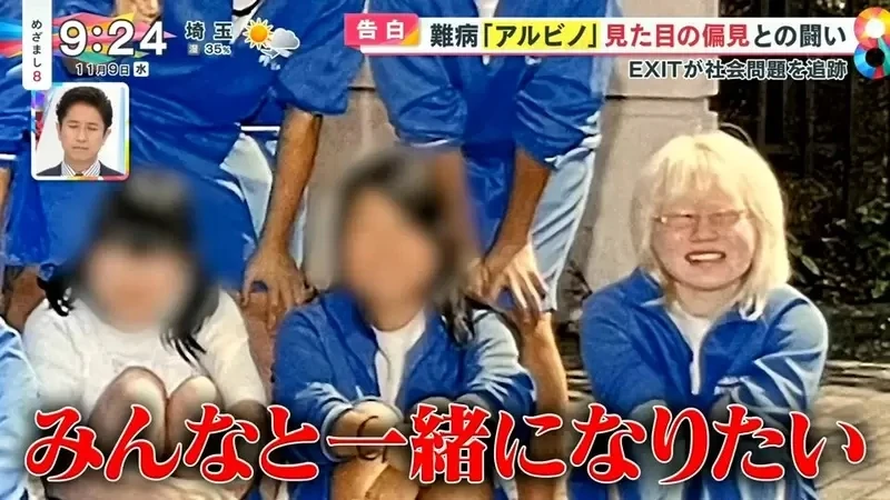 《白化症患者吐槽二次元》动漫里的白化症都是美少年美少女？害她从小总是莫名被嫌丑