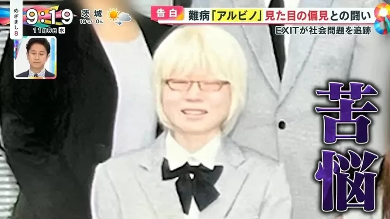 《白化症患者吐槽二次元》动漫里的白化症都是美少年美少女？害她从小总是莫名被嫌丑