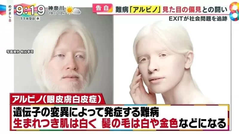 《白化症患者吐槽二次元》动漫里的白化症都是美少年美少女？害她从小总是莫名被嫌丑