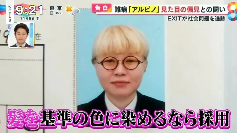 《白化症患者吐槽二次元》动漫里的白化症都是美少年美少女？害她从小总是莫名被嫌丑