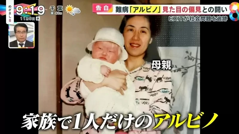 《白化症患者吐槽二次元》动漫里的白化症都是美少年美少女？害她从小总是莫名被嫌丑