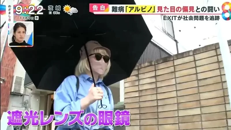 《白化症患者吐槽二次元》动漫里的白化症都是美少年美少女？害她从小总是莫名被嫌丑