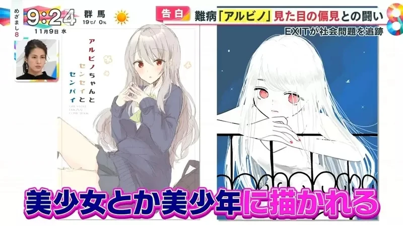 《白化症患者吐槽二次元》动漫里的白化症都是美少年美少女？害她从小总是莫名被嫌丑