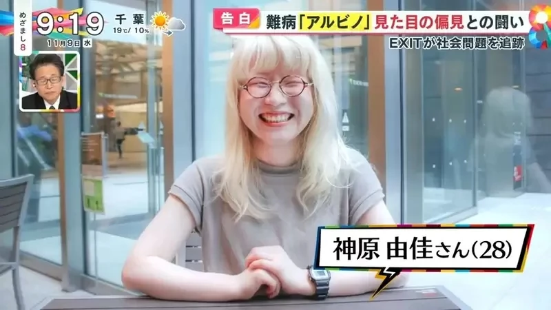 《白化症患者吐槽二次元》动漫里的白化症都是美少年美少女？害她从小总是莫名被嫌丑