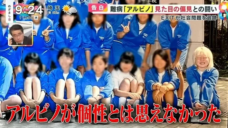 《白化症患者吐槽二次元》动漫里的白化症都是美少年美少女？害她从小总是莫名被嫌丑