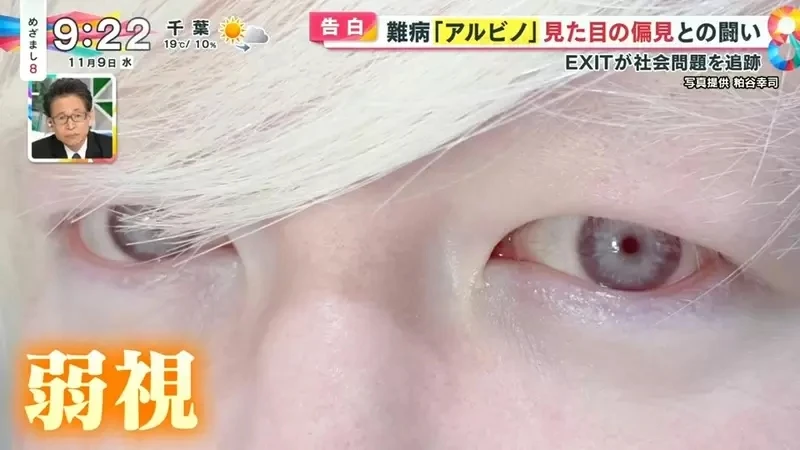 《白化症患者吐槽二次元》动漫里的白化症都是美少年美少女？害她从小总是莫名被嫌丑