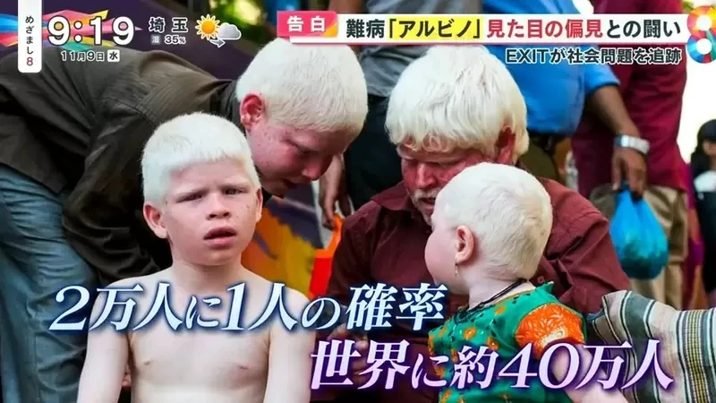 《白化症患者吐槽二次元》动漫里的白化症都是美少年美少女？害她从小总是莫名被嫌丑