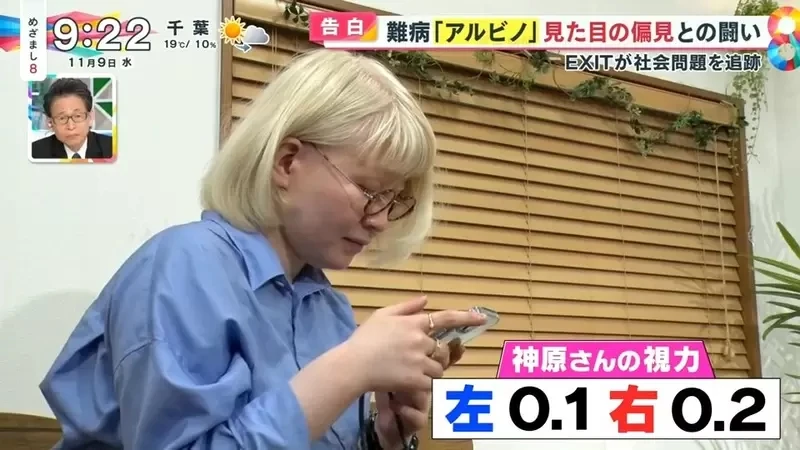 《白化症患者吐槽二次元》动漫里的白化症都是美少年美少女？害她从小总是莫名被嫌丑