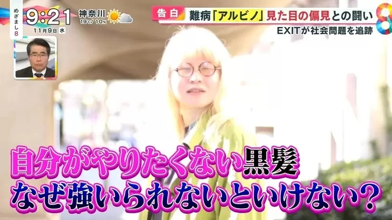 《白化症患者吐槽二次元》动漫里的白化症都是美少年美少女？害她从小总是莫名被嫌丑