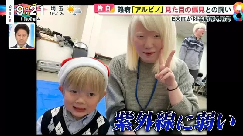 《白化症患者吐槽二次元》动漫里的白化症都是美少年美少女？害她从小总是莫名被嫌丑