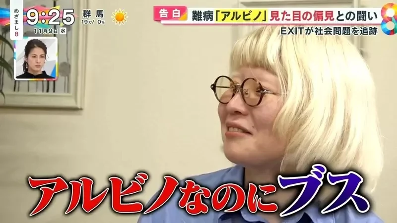 《白化症患者吐槽二次元》动漫里的白化症都是美少年美少女？害她从小总是莫名被嫌丑